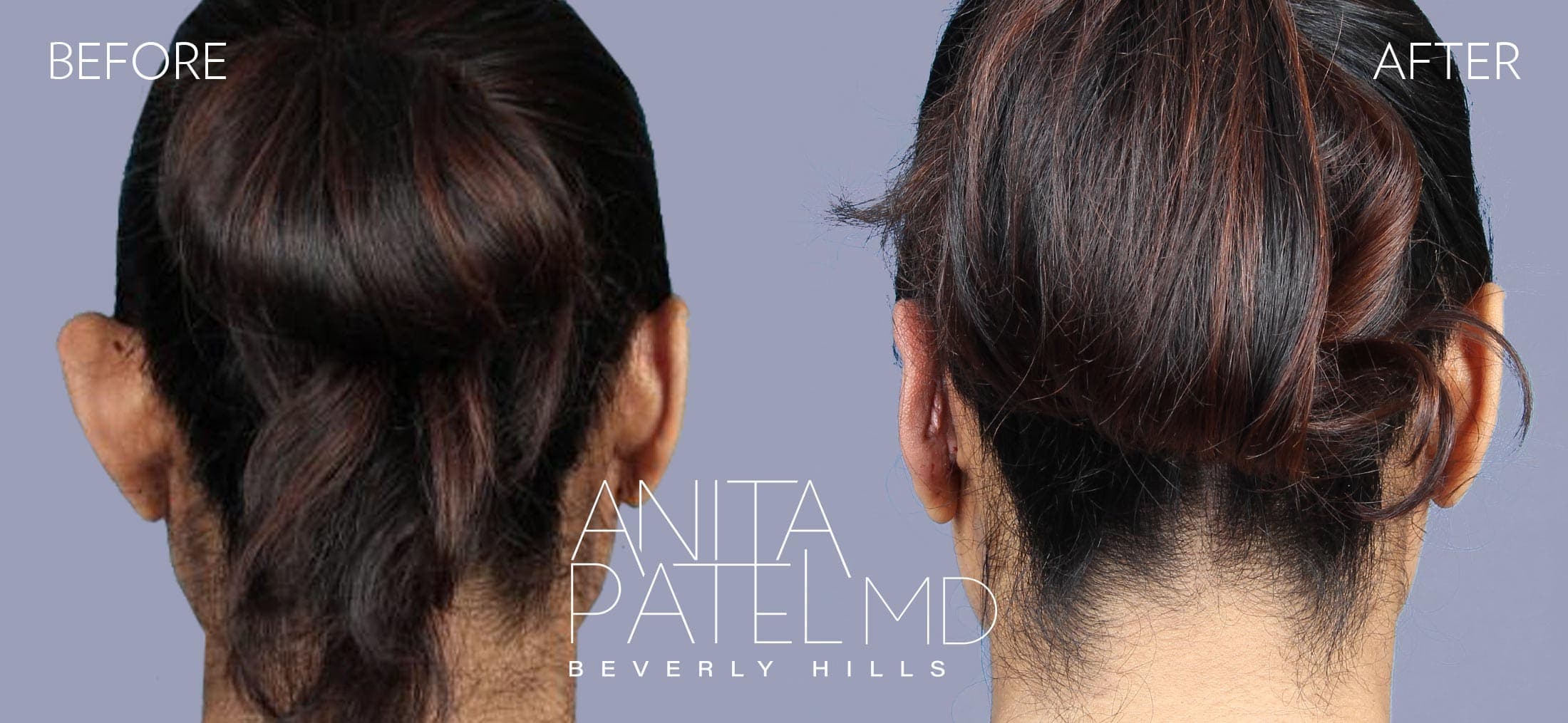 Otoplasty before and after — Patient 1, photo 2 of 3 — Dr. Anita Patel, MD, FACS, Beverly Hills