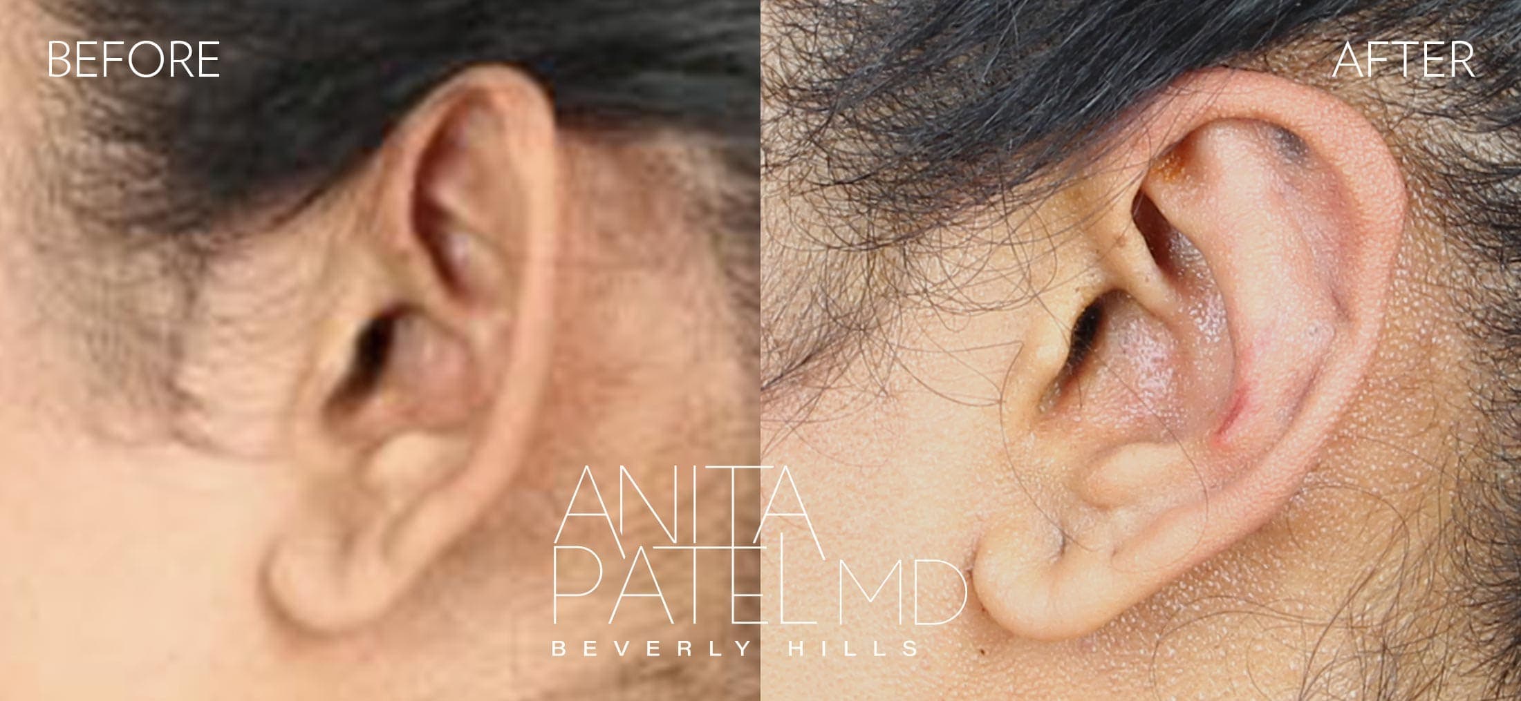 Otoplasty before and after — Patient 1, photo 3 of 3 — Dr. Anita Patel, MD, FACS, Beverly Hills