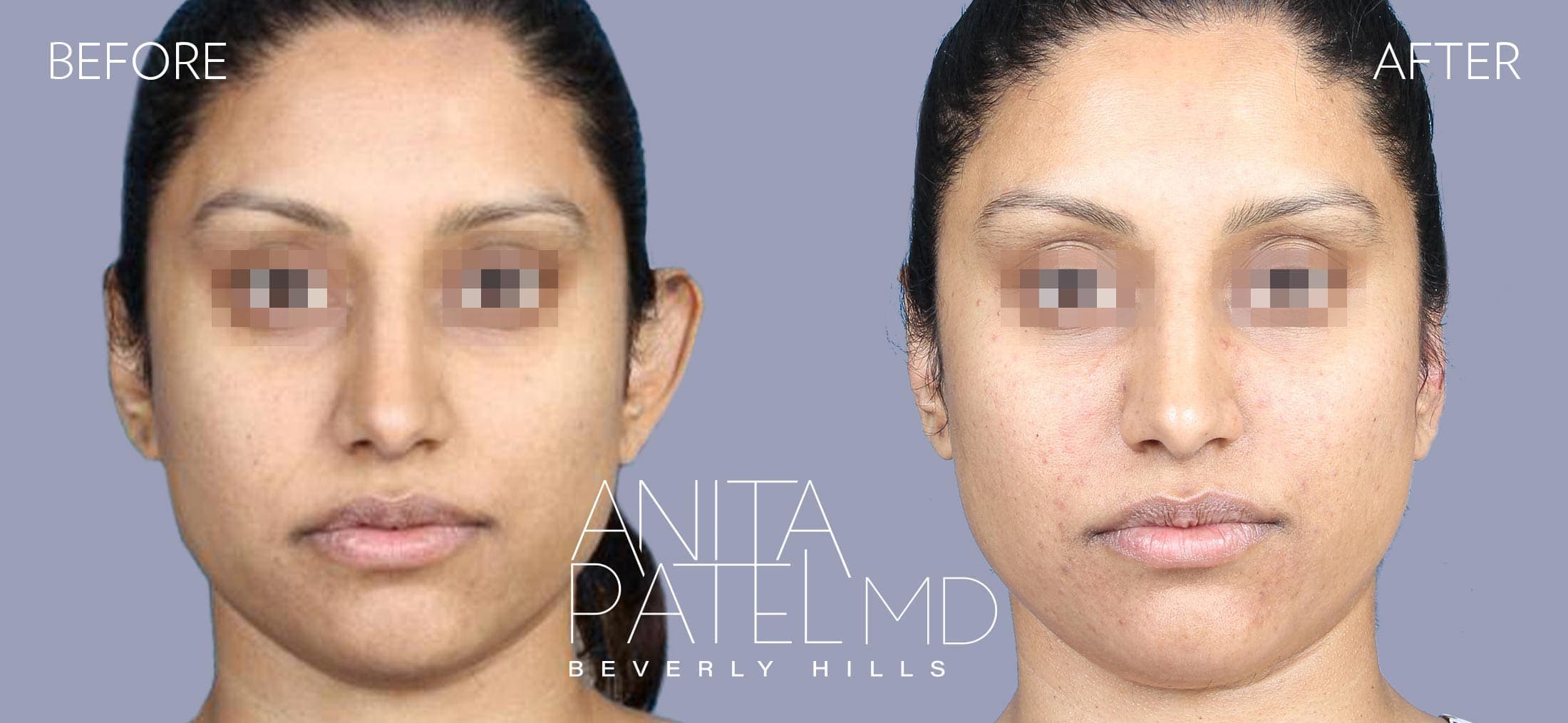 Otoplasty before and after — Dr. Anita Patel, Beverly Hills