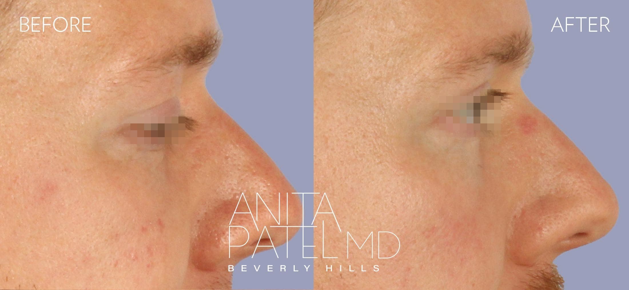 Selphyl® PRFM Facials and Injections before and after — Dr. Anita Patel, Beverly Hills