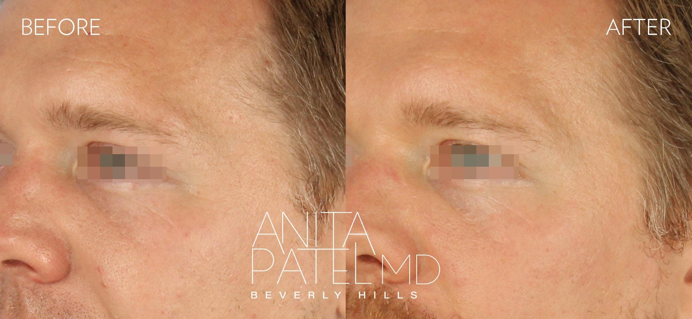 Selphyl® PRFM Facials and Injections before and after — Patient 1, photo 2 of 5 — Dr. Anita Patel, MD, FACS, Beverly Hills