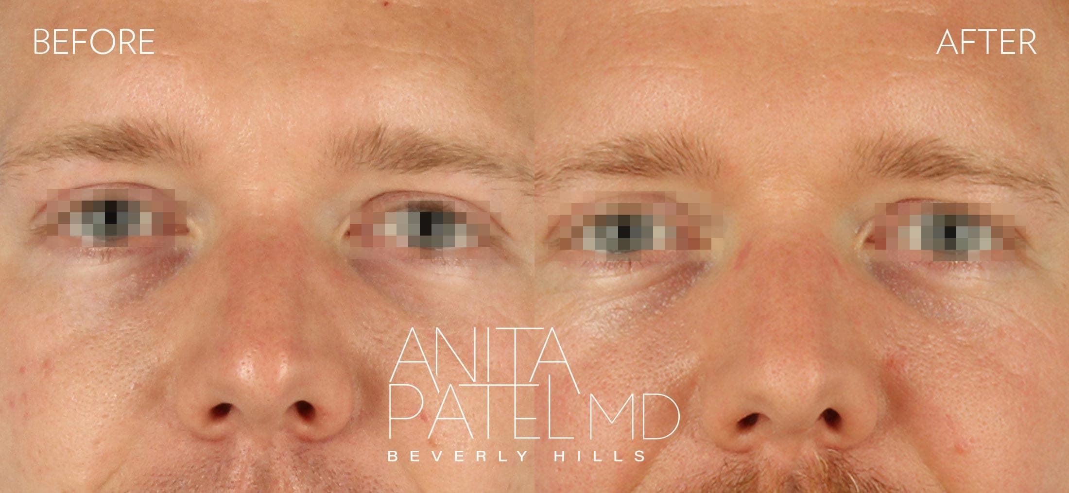 Selphyl® PRFM Facials and Injections before and after — Patient 1, photo 3 of 5 — Dr. Anita Patel, MD, FACS, Beverly Hills