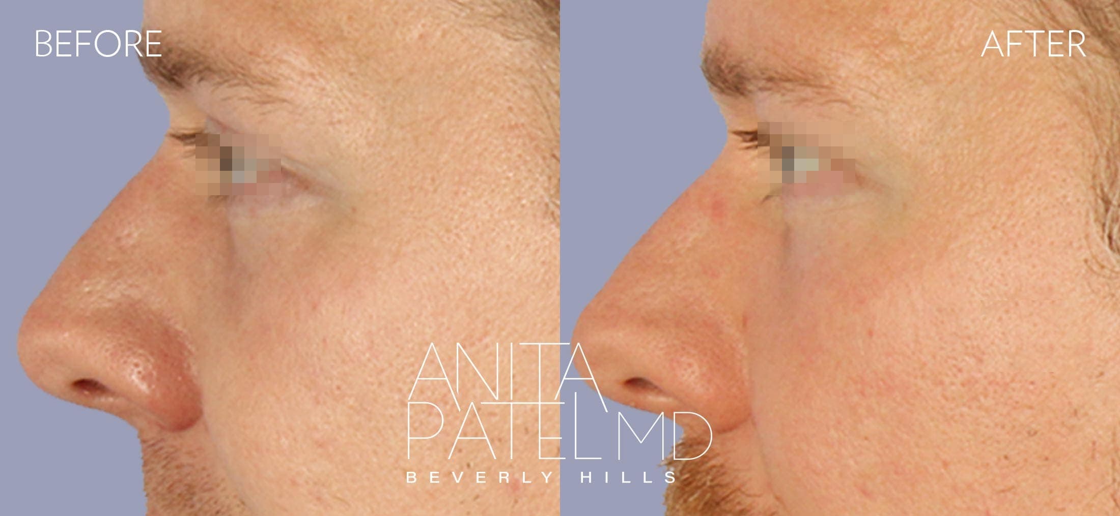 Selphyl® PRFM Facials and Injections before and after — Patient 1, photo 4 of 5 — Dr. Anita Patel, MD, FACS, Beverly Hills
