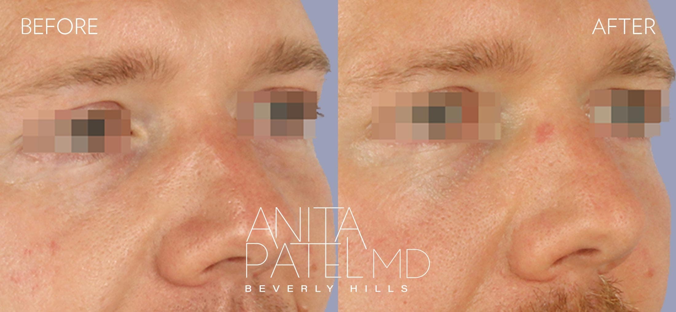 Selphyl® PRFM Facials and Injections before and after — Patient 1, photo 5 of 5 — Dr. Anita Patel, MD, FACS, Beverly Hills
