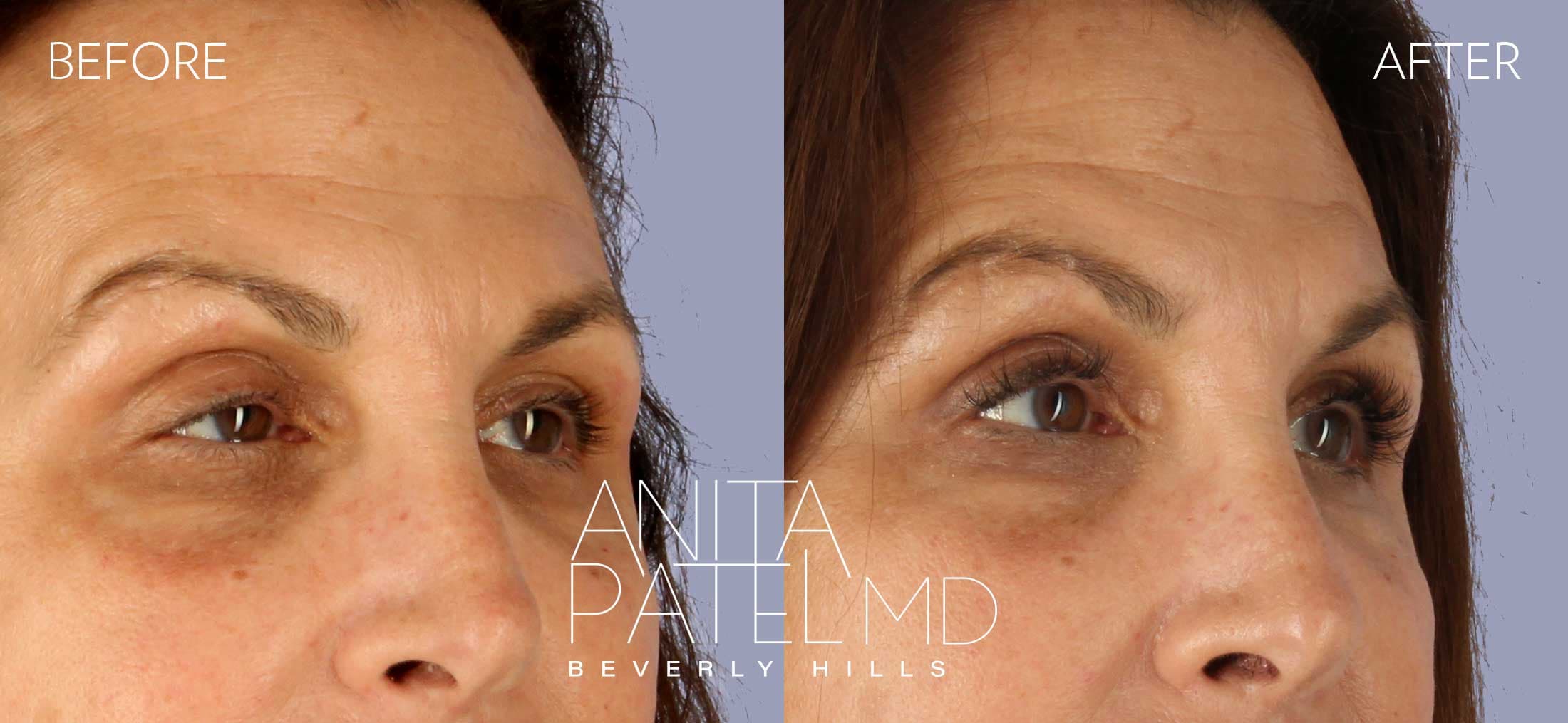 Selphyl® PRFM Facials and Injections before and after — Patient 3, photo 1 of 4 — Dr. Anita Patel, MD, FACS, Beverly Hills