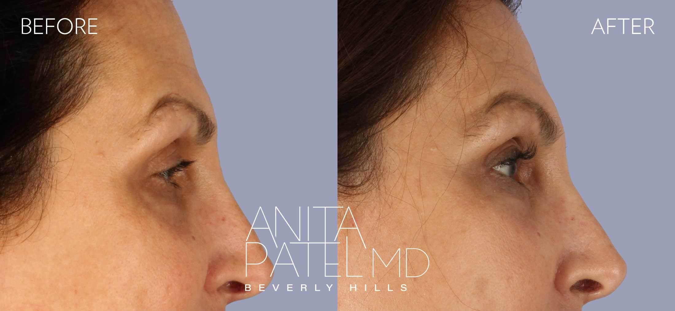 Selphyl® PRFM Facials and Injections before and after — Patient 3, photo 2 of 4 — Dr. Anita Patel, MD, FACS, Beverly Hills