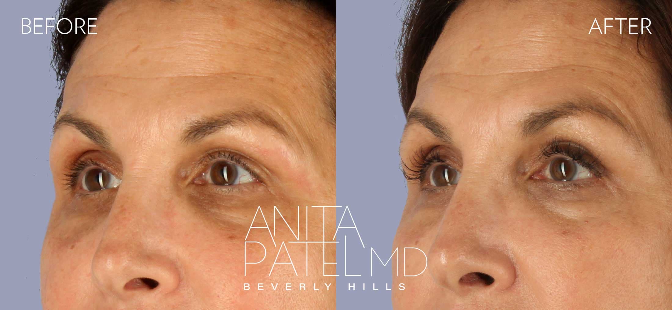 Selphyl® PRFM Facials and Injections before and after — Patient 3, photo 3 of 4 — Dr. Anita Patel, MD, FACS, Beverly Hills