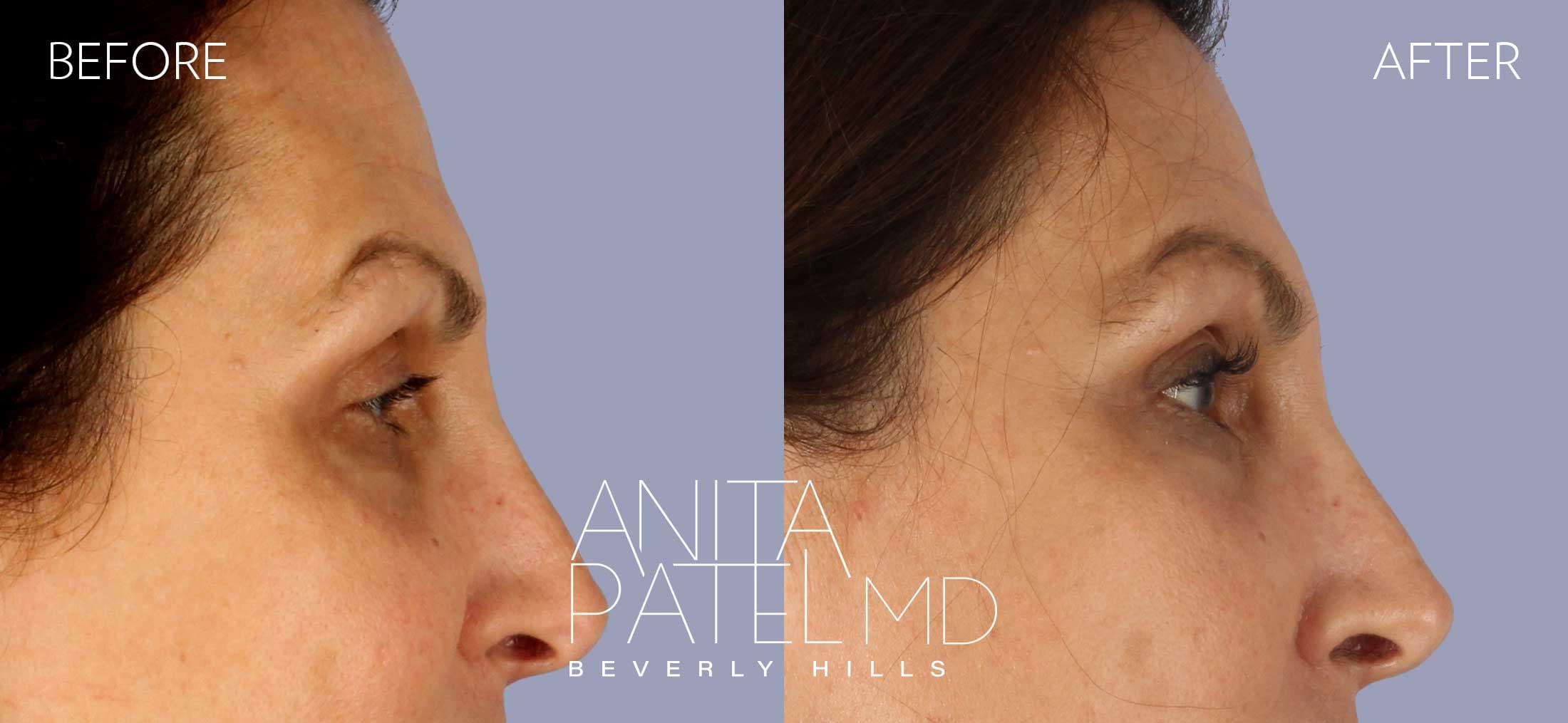 Selphyl® PRFM Facials and Injections before and after — Patient 3, photo 4 of 4 — Dr. Anita Patel, MD, FACS, Beverly Hills