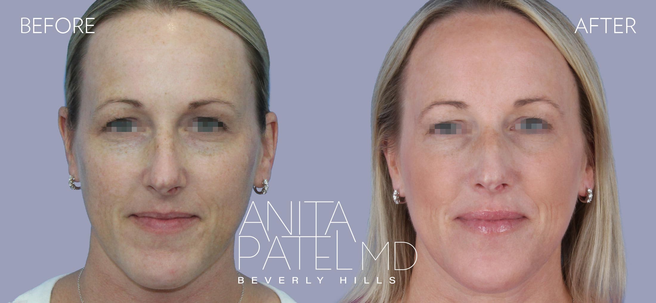 Fractional Laser Aesthetic Treatment before and after — Dr. Anita Patel, Beverly Hills