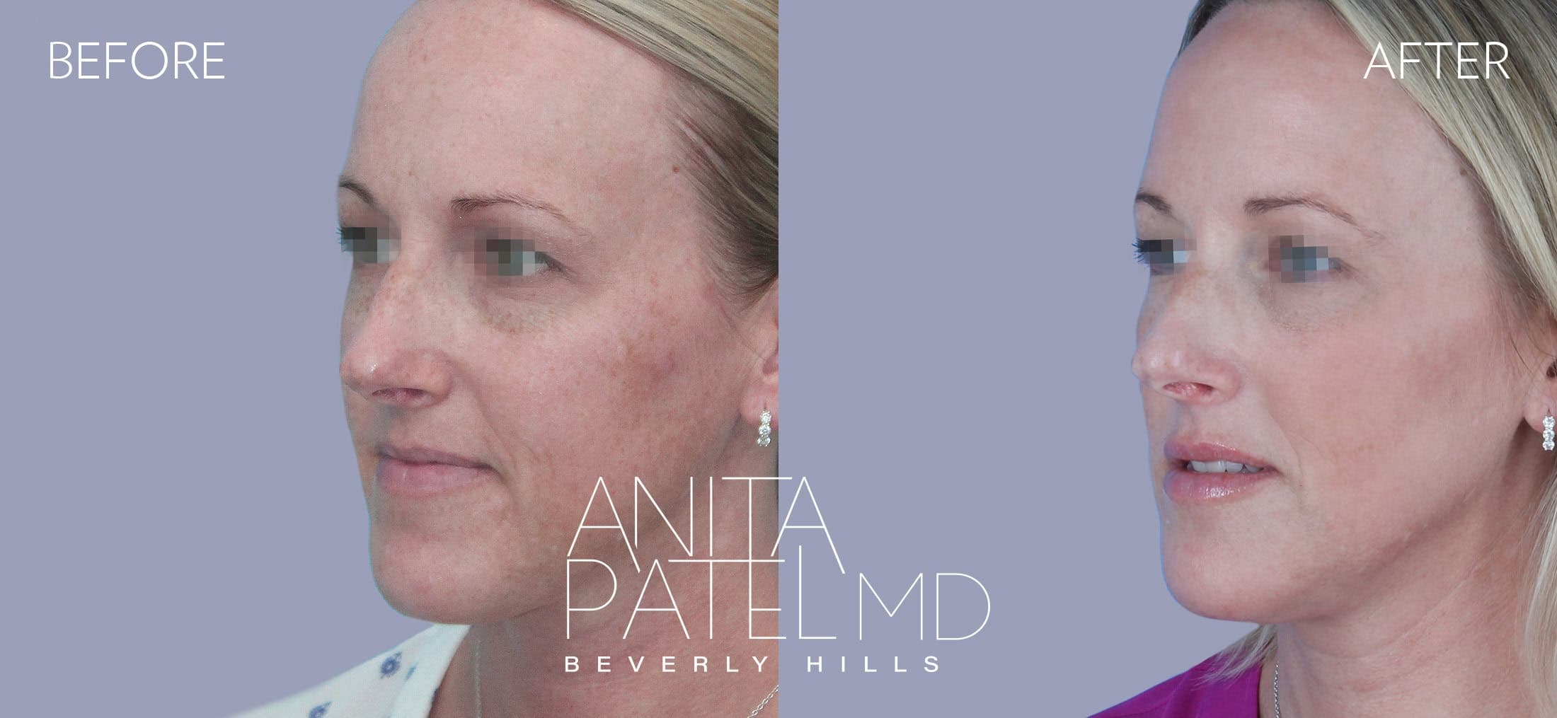 Cynosure®️ Palomar Icon™️ 1540 before and after — Patient 1, photo 2 of 5 — Dr. Anita Patel, MD, FACS, Beverly Hills