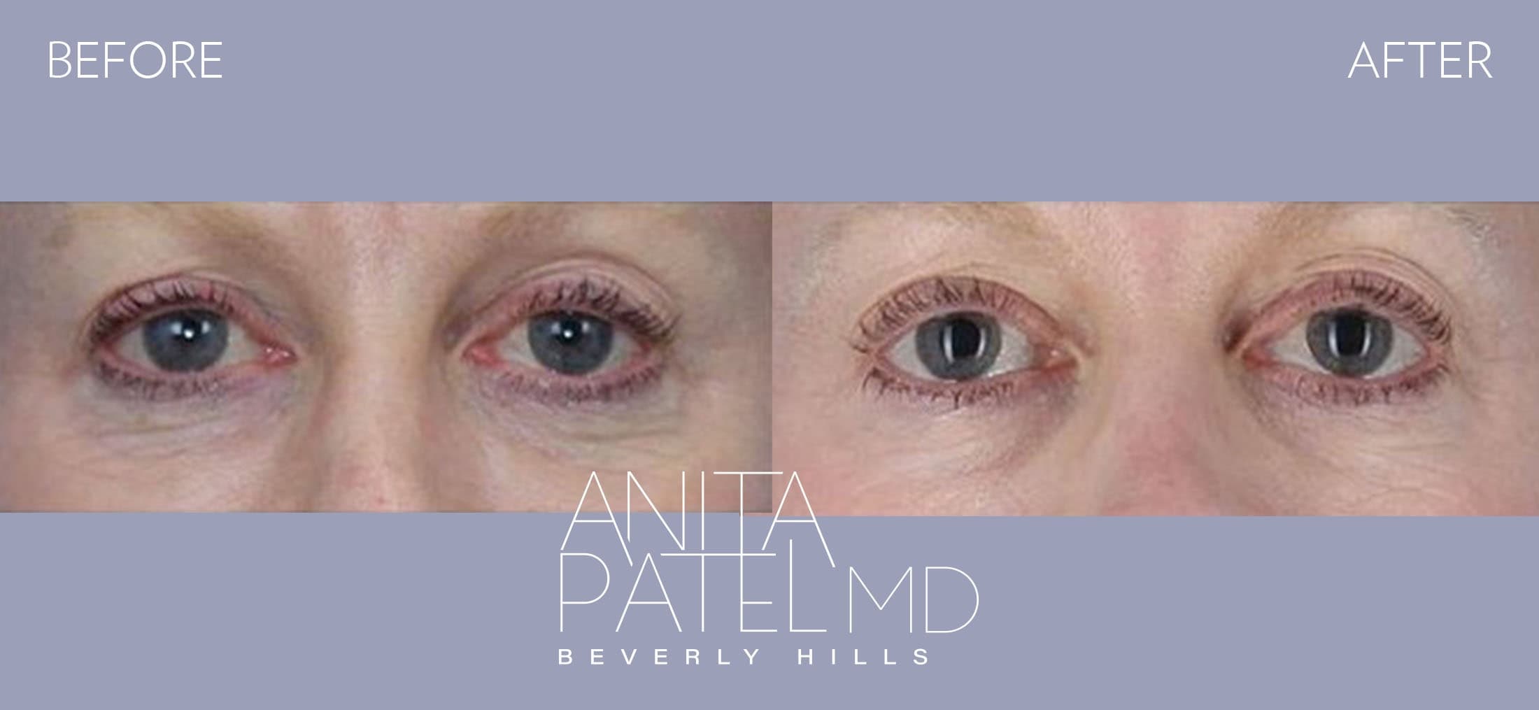 Fractional Laser Aesthetic Treatment before and after — Patient 4 — Dr. Anita Patel, MD, FACS, Beverly Hills