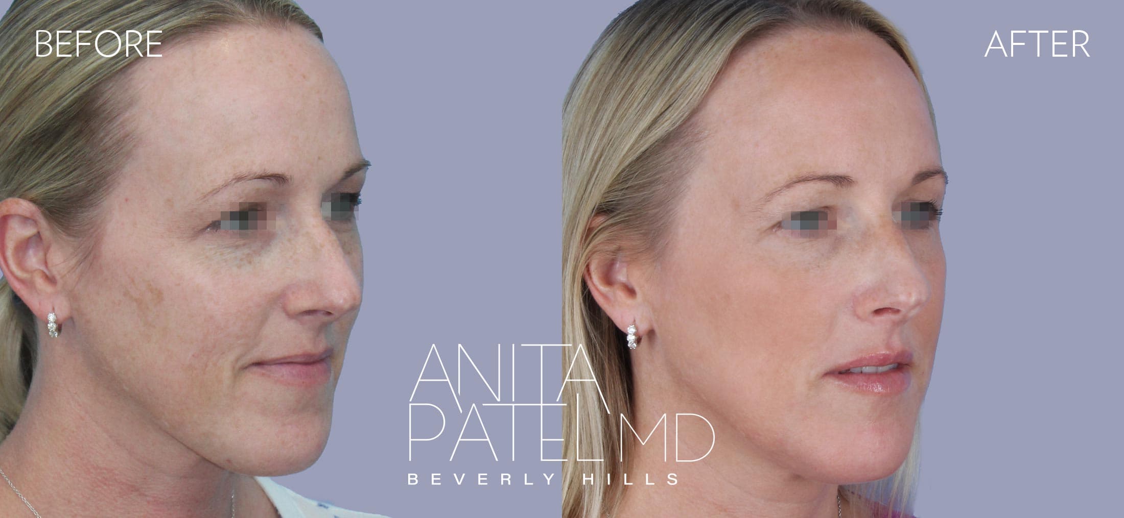 Fractional Laser Aesthetic Treatment before and after — Patient 1, photo 3 of 5 — Dr. Anita Patel, MD, FACS, Beverly Hills