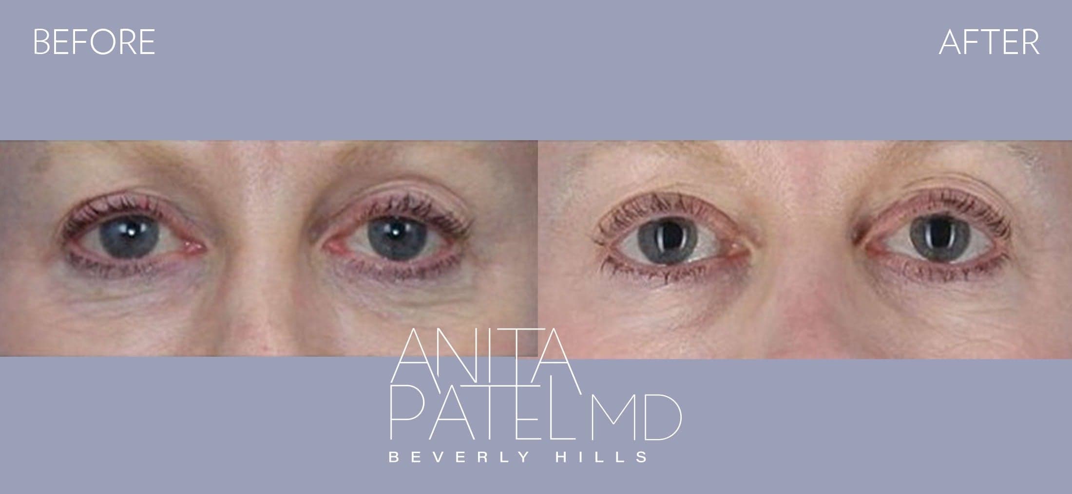 Cynosure®️ Palomar Icon™️ 1540 before and after — Patient 1, photo 3 of 5 — Dr. Anita Patel, MD, FACS, Beverly Hills