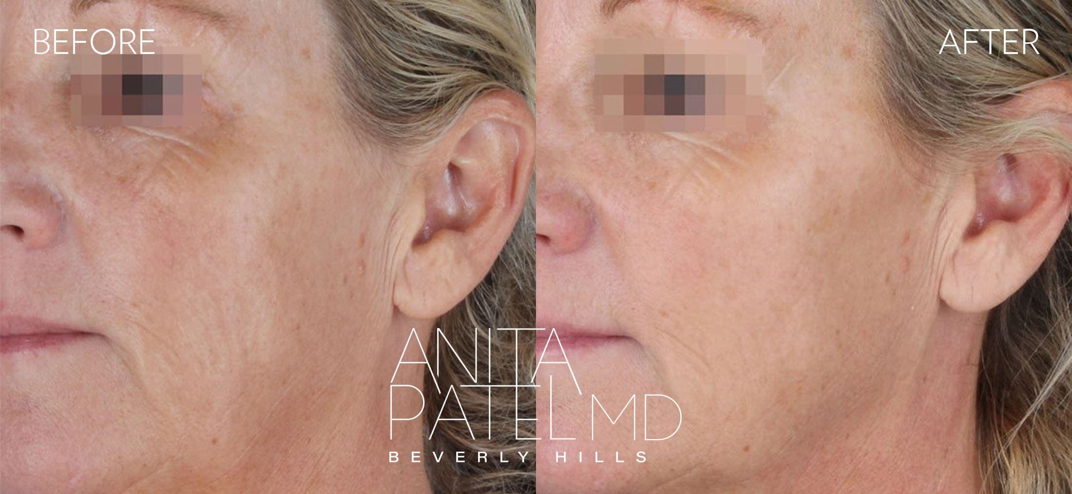 Fractional Laser Aesthetic Treatment before and after — Patient 2 — Dr. Anita Patel, MD, FACS, Beverly Hills