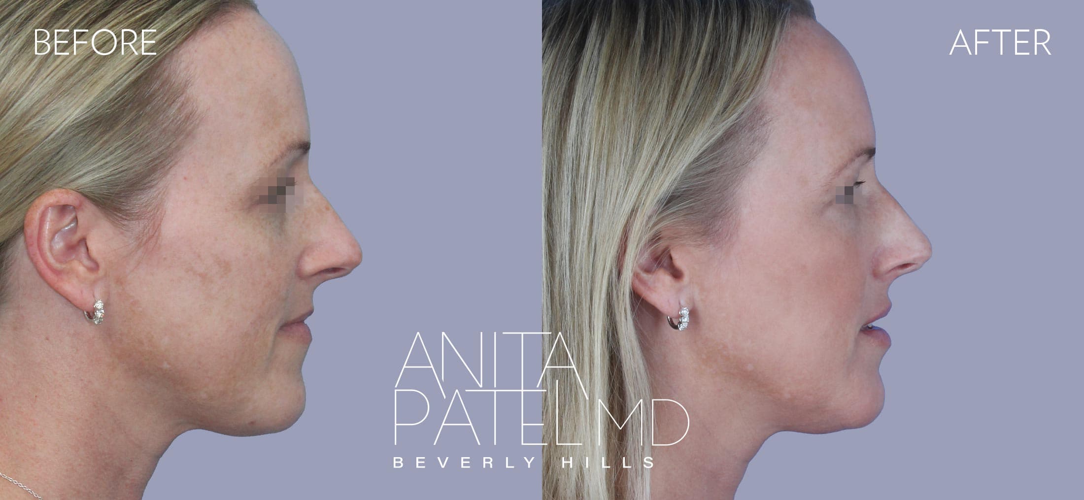 Fractional Laser Aesthetic Treatment before and after — Patient 1, photo 4 of 5 — Dr. Anita Patel, MD, FACS, Beverly Hills
