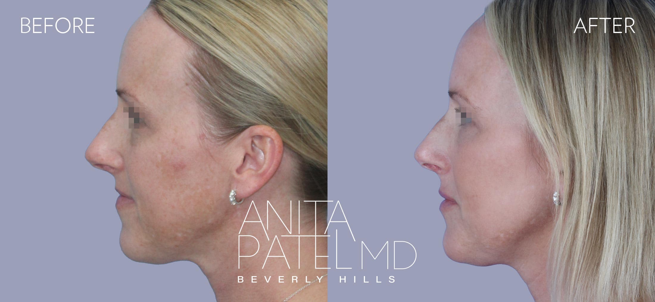 Fractional Laser Aesthetic Treatment before and after — Patient 1, photo 5 of 5 — Dr. Anita Patel, MD, FACS, Beverly Hills
