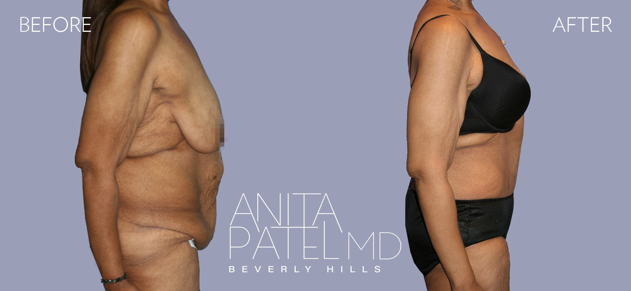 Panniculectomy before and after — Patient 1, photo 2 of 5 — Dr. Anita Patel, MD, FACS, Beverly Hills