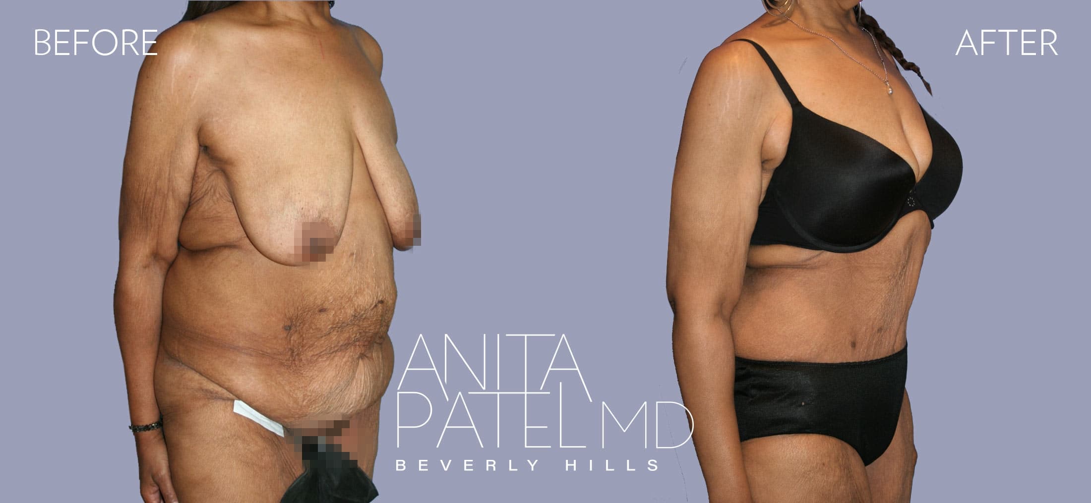 Panniculectomy before and after — Patient 1, photo 3 of 5 — Dr. Anita Patel, MD, FACS, Beverly Hills