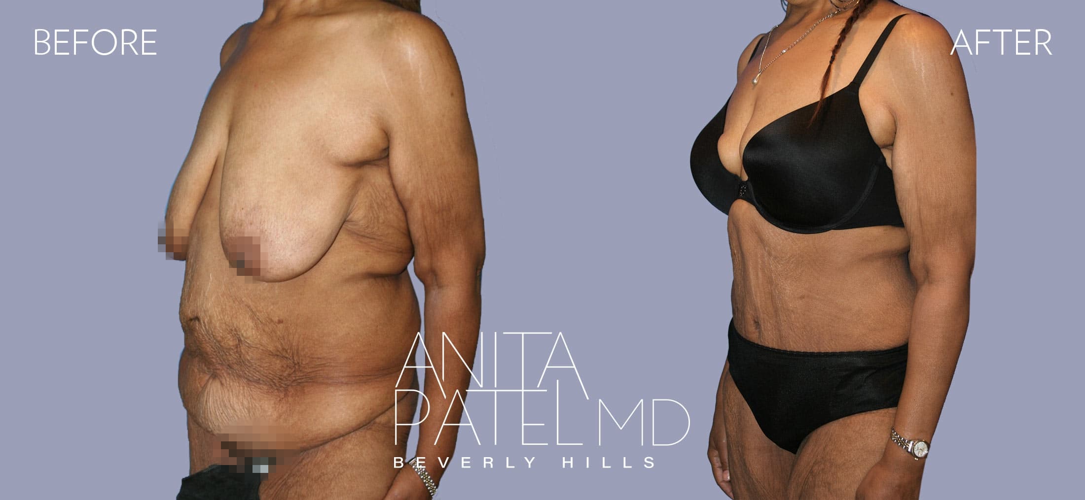 Panniculectomy before and after — Patient 1, photo 4 of 5 — Dr. Anita Patel, MD, FACS, Beverly Hills