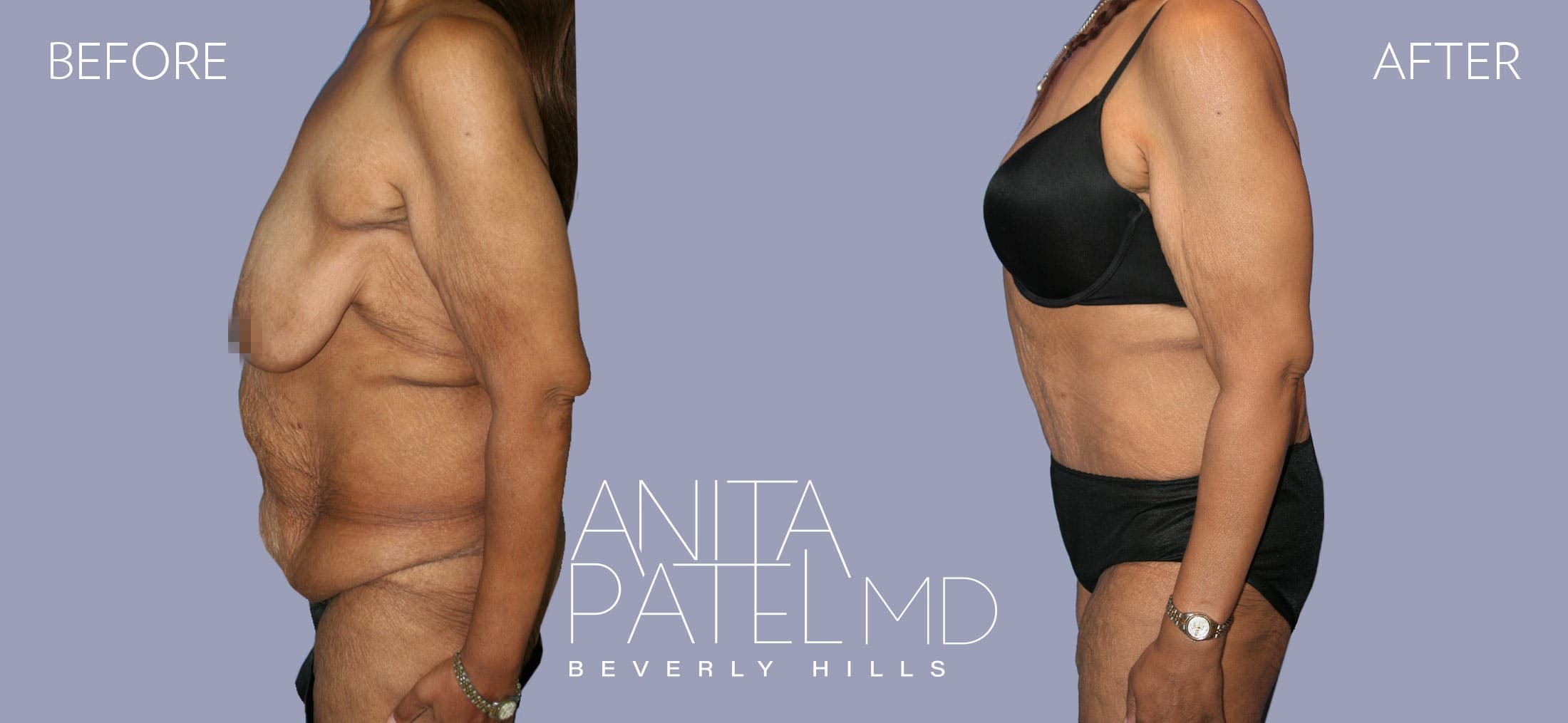 Panniculectomy before and after — Patient 1, photo 5 of 5 — Dr. Anita Patel, MD, FACS, Beverly Hills