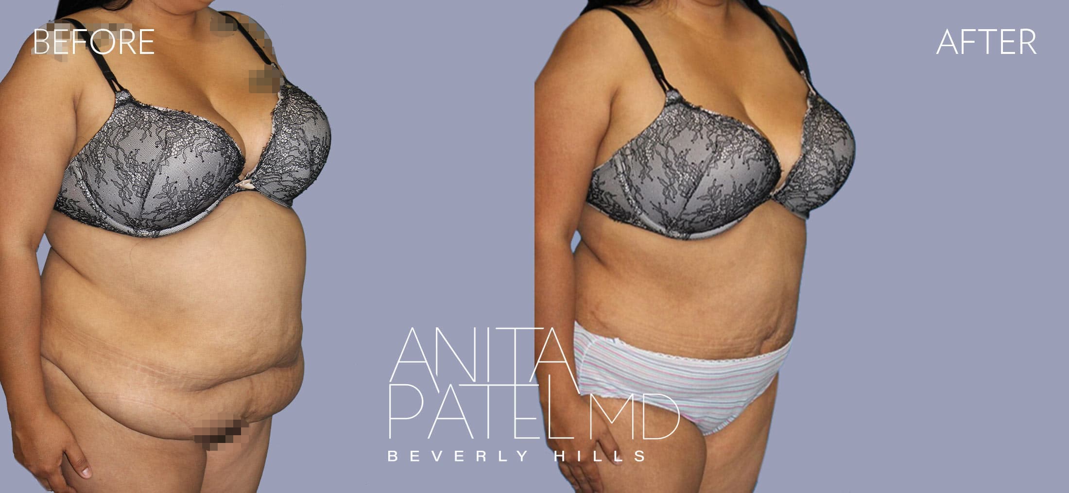 Panniculectomy before and after — Patient 2, photo 1 of 3 — Dr. Anita Patel, MD, FACS, Beverly Hills