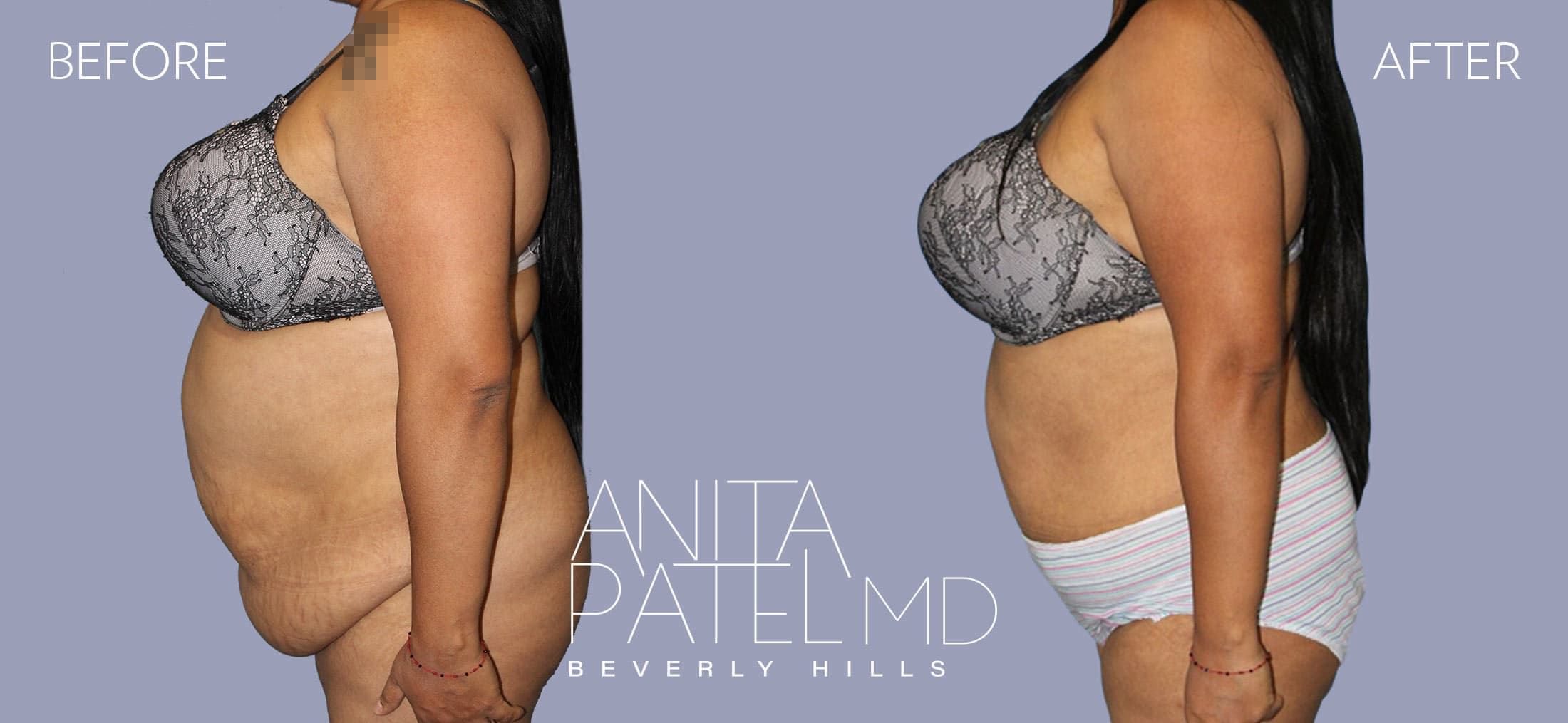 Panniculectomy before and after — Patient 2, photo 2 of 3 — Dr. Anita Patel, MD, FACS, Beverly Hills