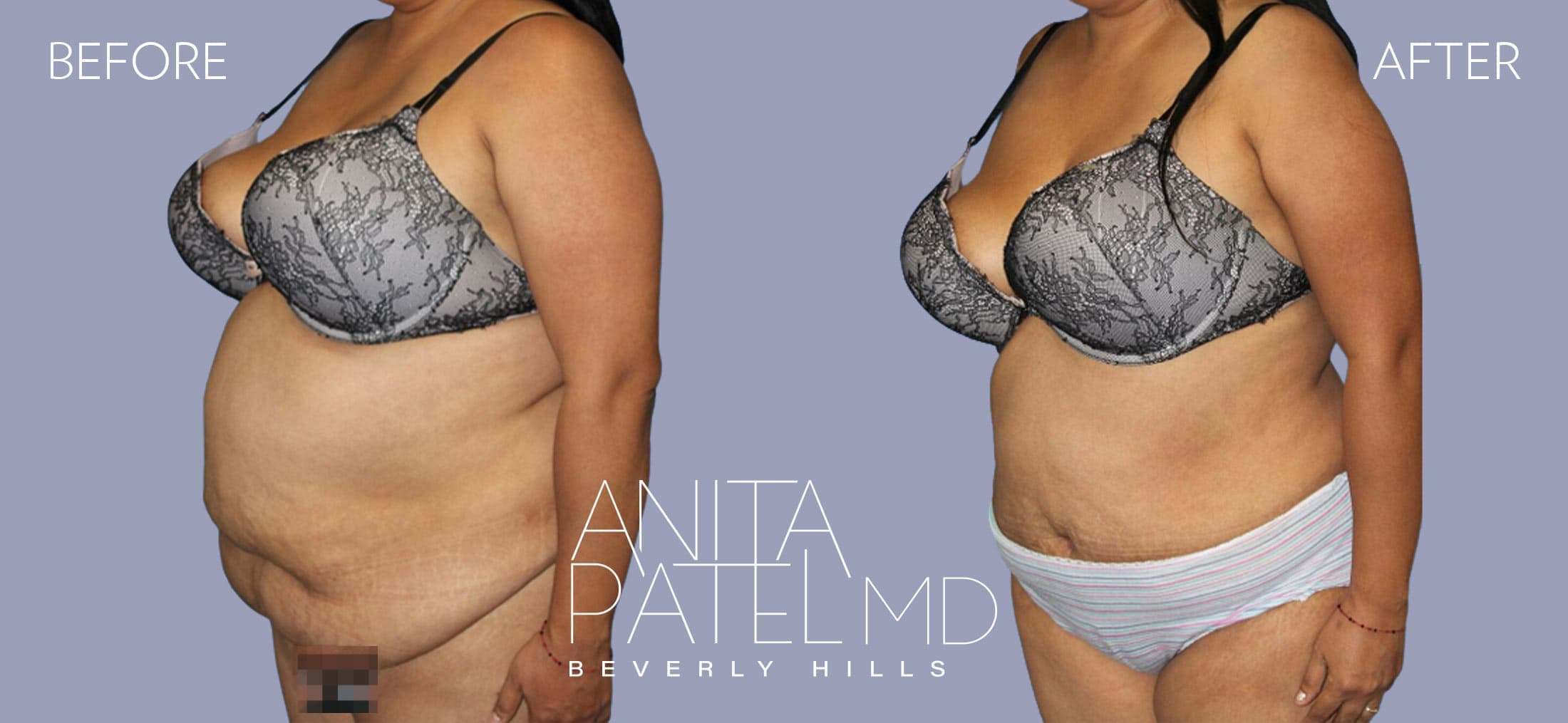 Panniculectomy before and after — Patient 2, photo 3 of 3 — Dr. Anita Patel, MD, FACS, Beverly Hills