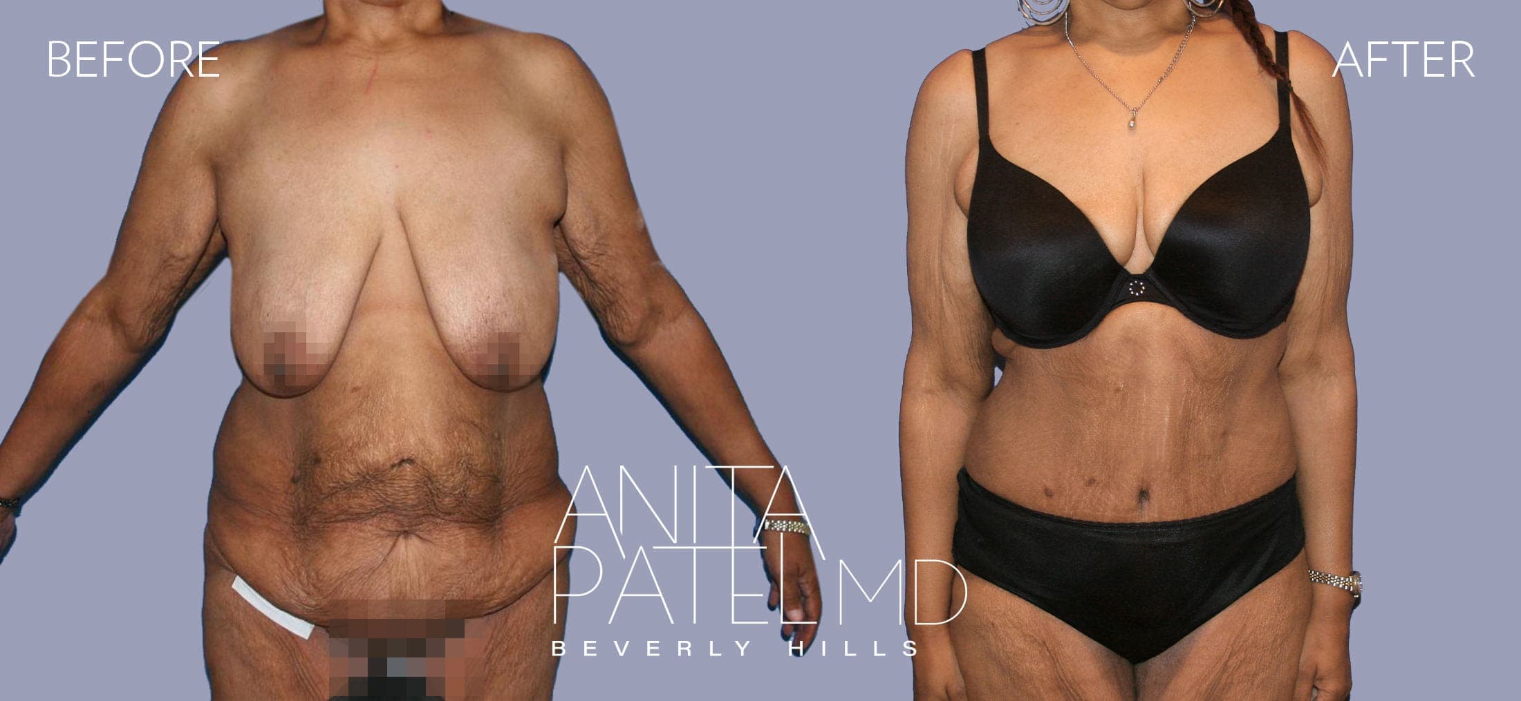 Panniculectomy before and after — Patient 1, photo 1 of 5 — Dr. Anita Patel, MD, FACS, Beverly Hills