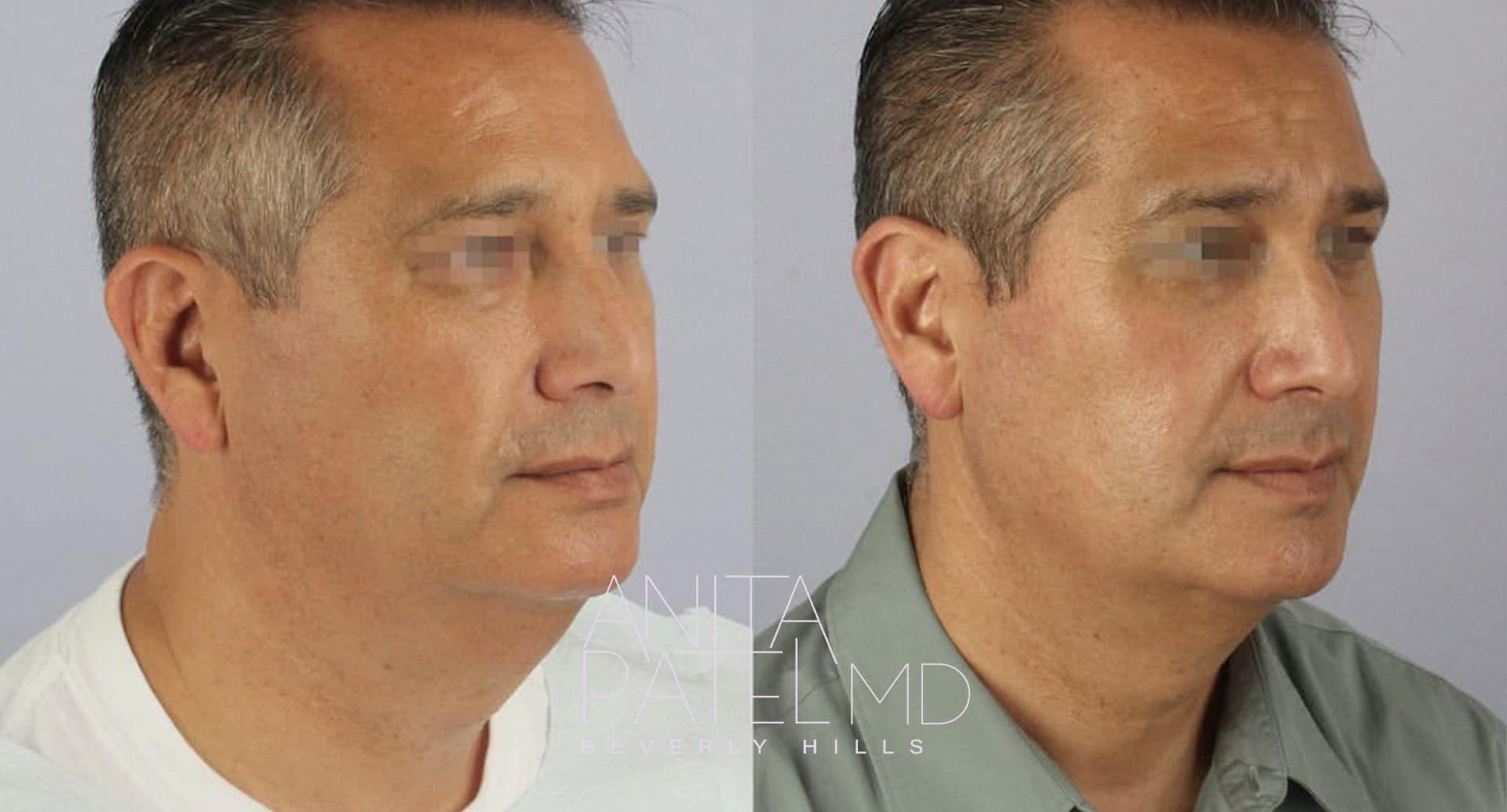 Kybella before and after — Patient 3 — Dr. Anita Patel, MD, FACS, Beverly Hills