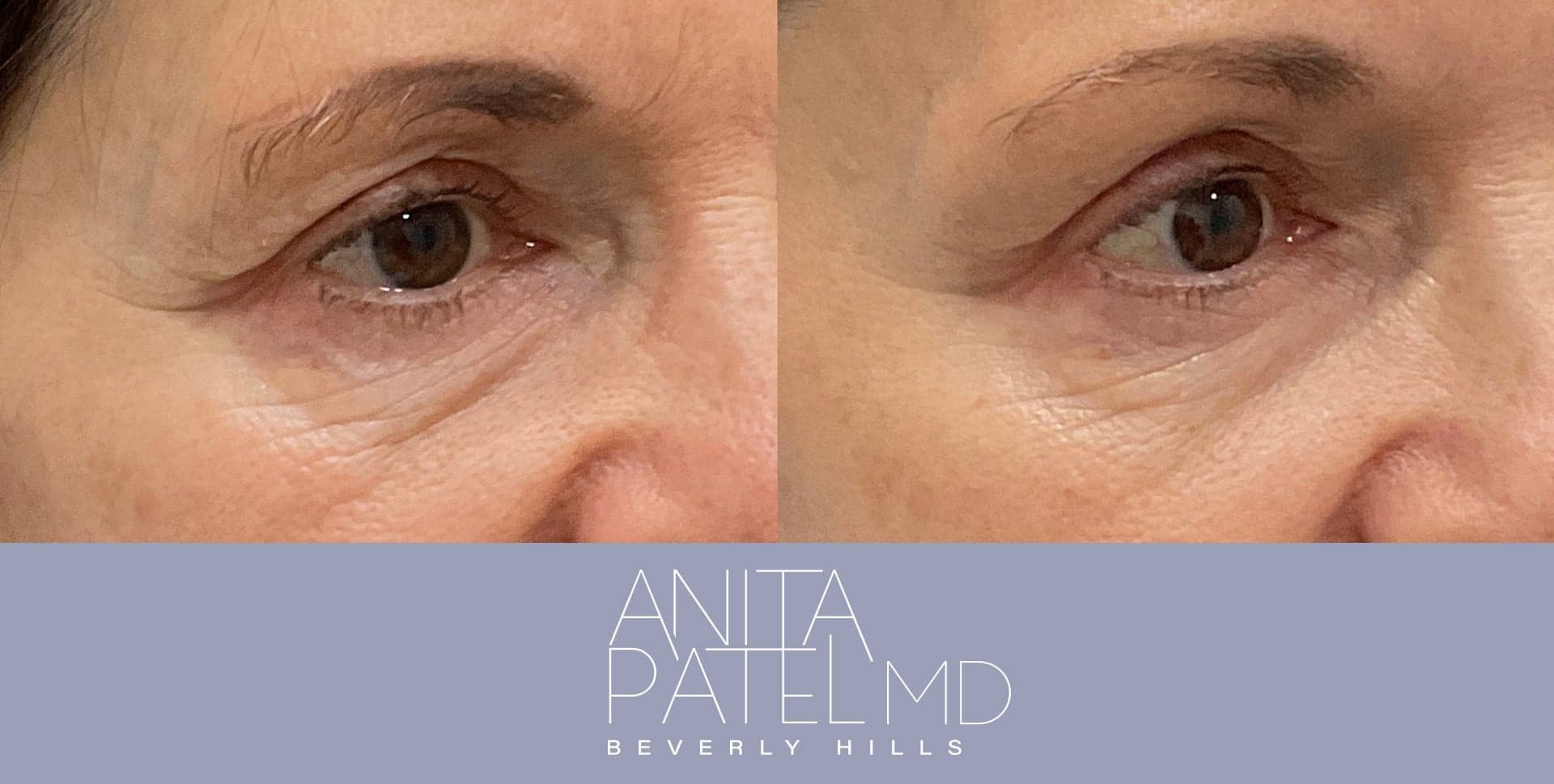 Morpheus8 RF Microneedling before and after — Patient 1 — Dr. Anita Patel, MD, FACS, Beverly Hills