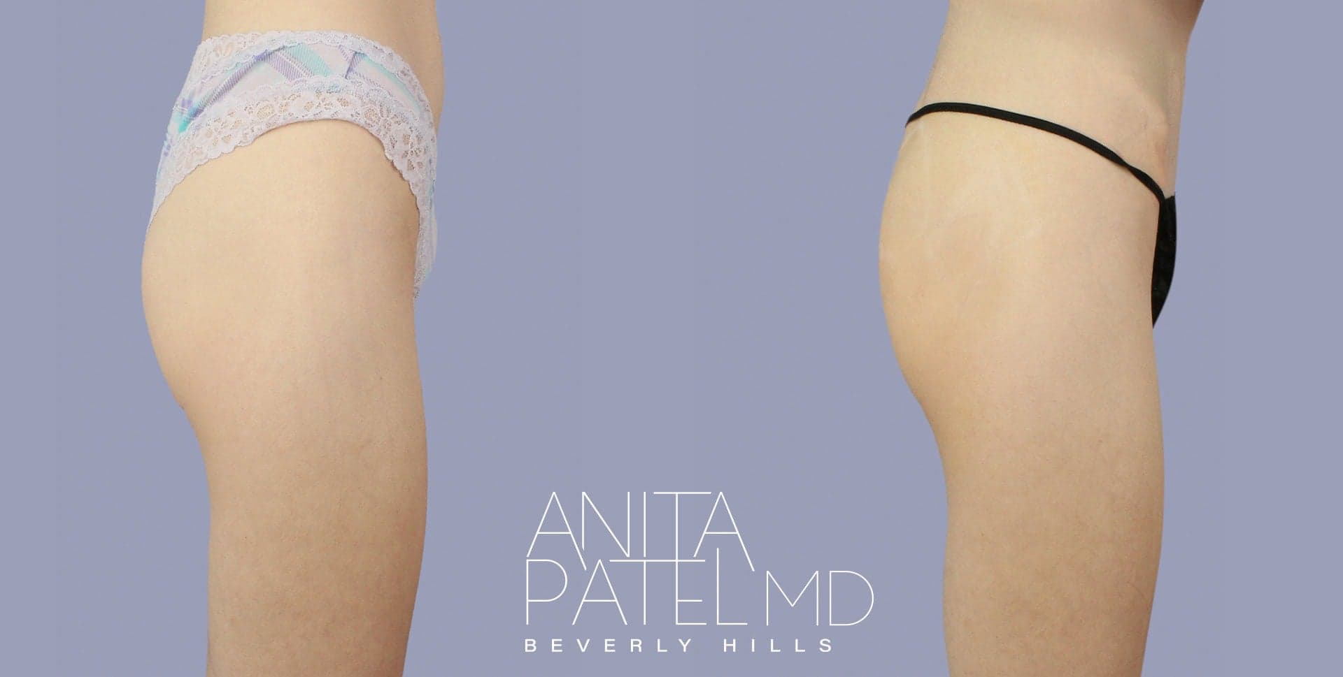 Renuva before and after — Dr. Anita Patel, Beverly Hills