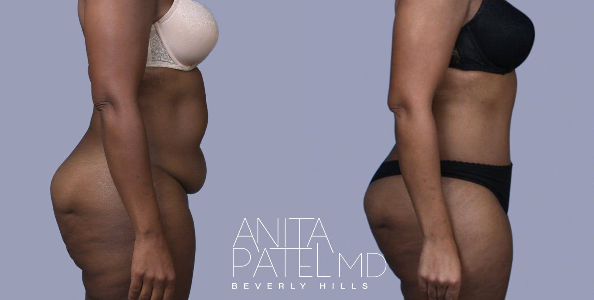 Tummy Tuck before and after — Patient 2, photo 2 of 3 — Dr. Anita Patel, MD, FACS, Beverly Hills