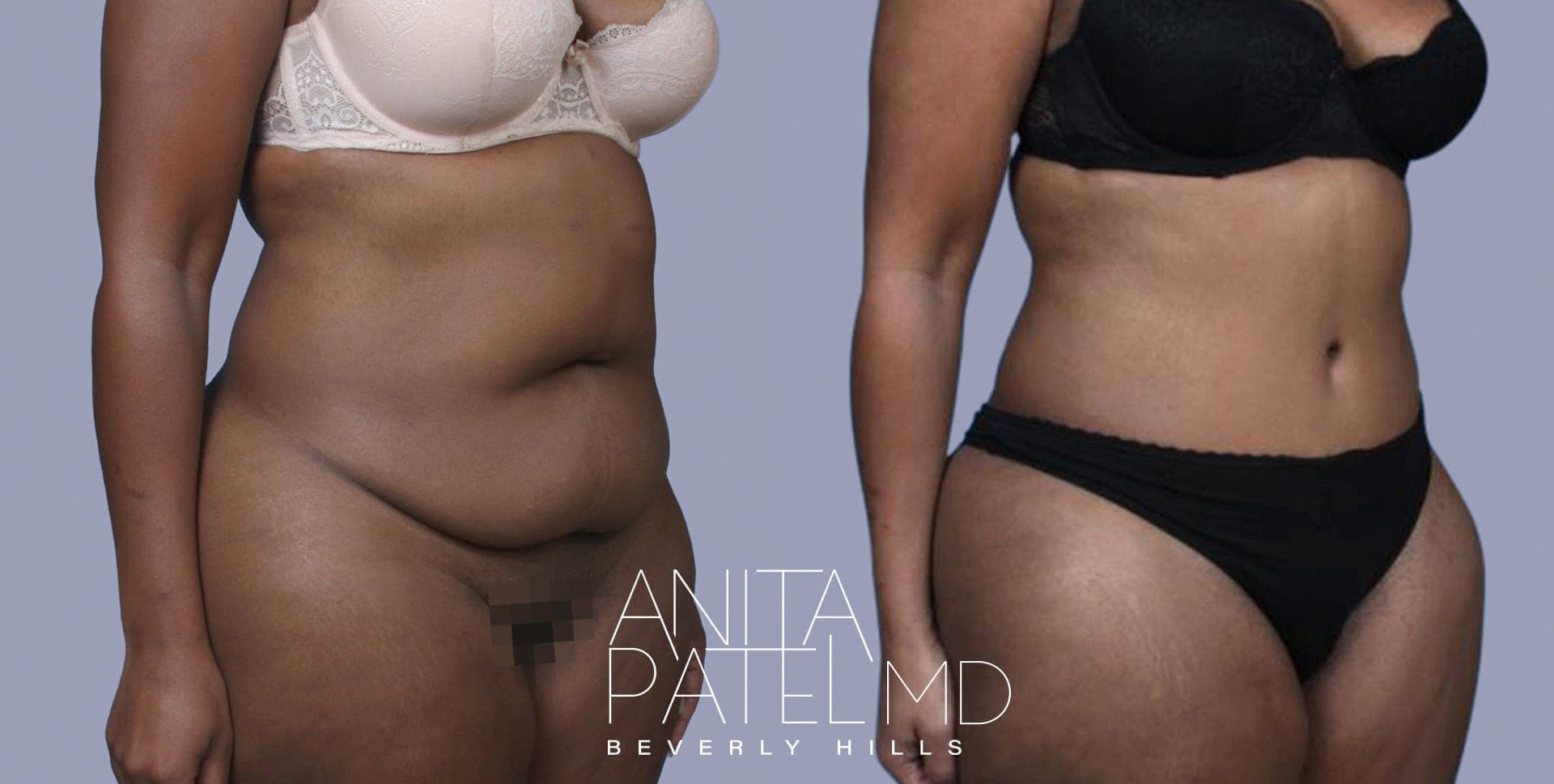 Tummy Tuck before and after — Patient 2, photo 3 of 3 — Dr. Anita Patel, MD, FACS, Beverly Hills