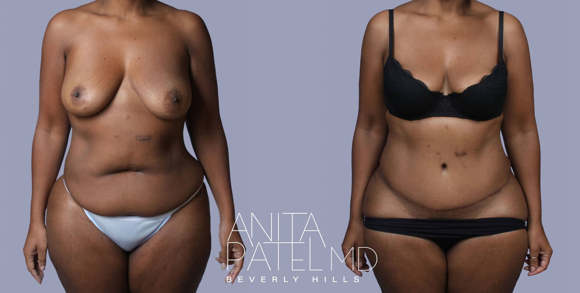 Tummy Tuck before and after — Patient 2, photo 1 of 3 — Dr. Anita Patel, MD, FACS, Beverly Hills