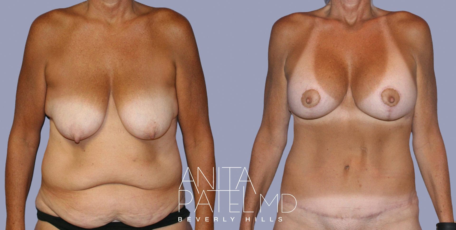 Tummy Tuck before and after — Patient 2C, photo 1 of 5 — Dr. Anita Patel, MD, FACS, Beverly Hills