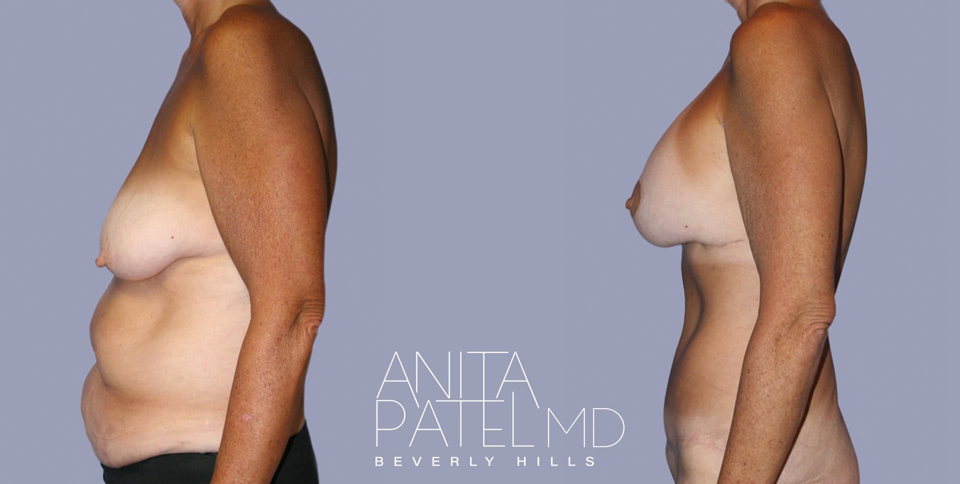 Tummy Tuck before and after — Patient 2C, photo 3 of 5 — Dr. Anita Patel, MD, FACS, Beverly Hills