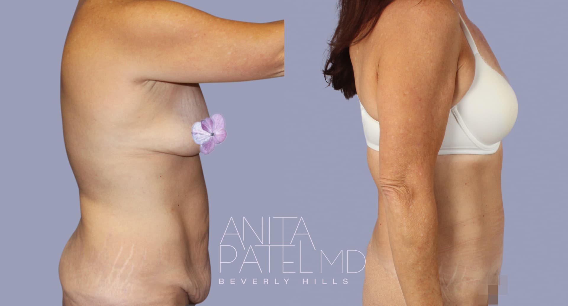 Tummy Tuck before and after — Patient 9 — Dr. Anita Patel, MD, FACS, Beverly Hills