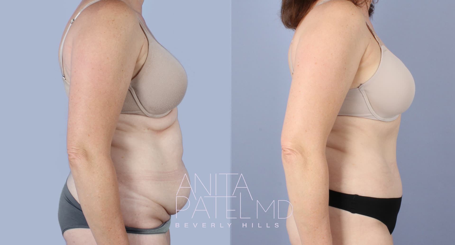 Tummy Tuck before and after — Patient 10 — Dr. Anita Patel, MD, FACS, Beverly Hills