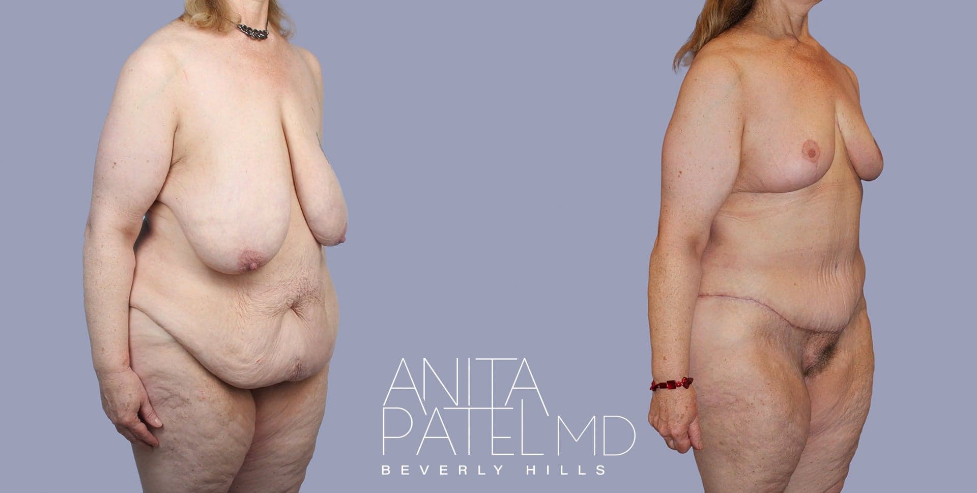 Monsplasty before and after — Patient 4, photo 1 of 5 — Dr. Anita Patel, MD, FACS, Beverly Hills