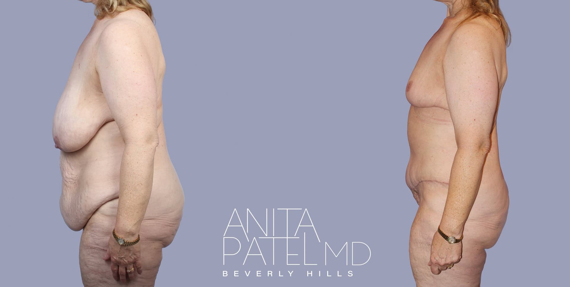 Monsplasty before and after — Patient 4, photo 2 of 5 — Dr. Anita Patel, MD, FACS, Beverly Hills