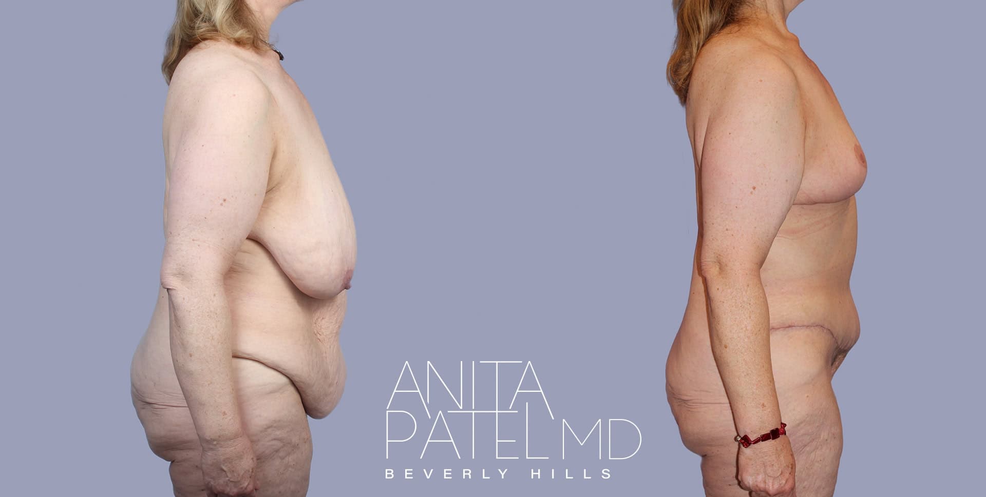 Monsplasty before and after — Patient 4, photo 3 of 5 — Dr. Anita Patel, MD, FACS, Beverly Hills