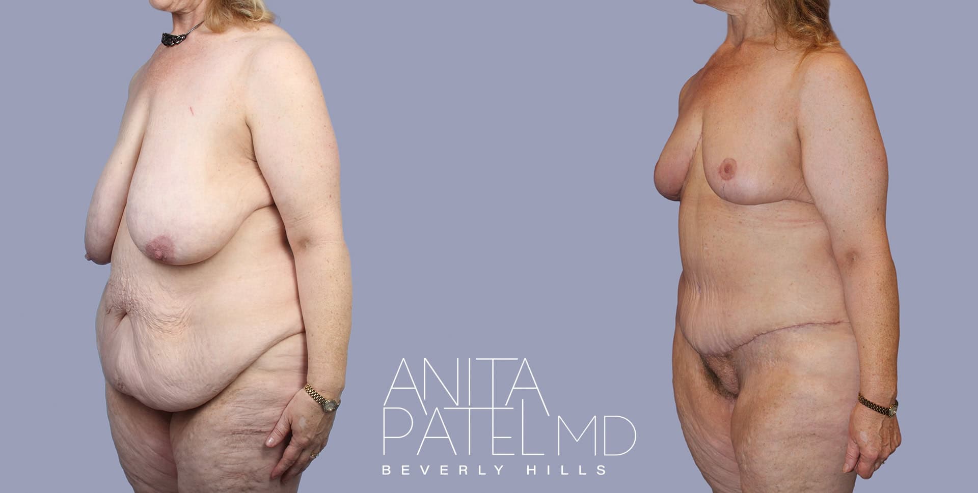 Monsplasty before and after — Patient 4, photo 4 of 5 — Dr. Anita Patel, MD, FACS, Beverly Hills