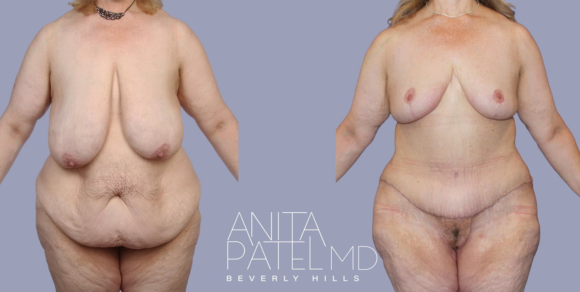 Monsplasty before and after — Patient 4, photo 5 of 5 — Dr. Anita Patel, MD, FACS, Beverly Hills