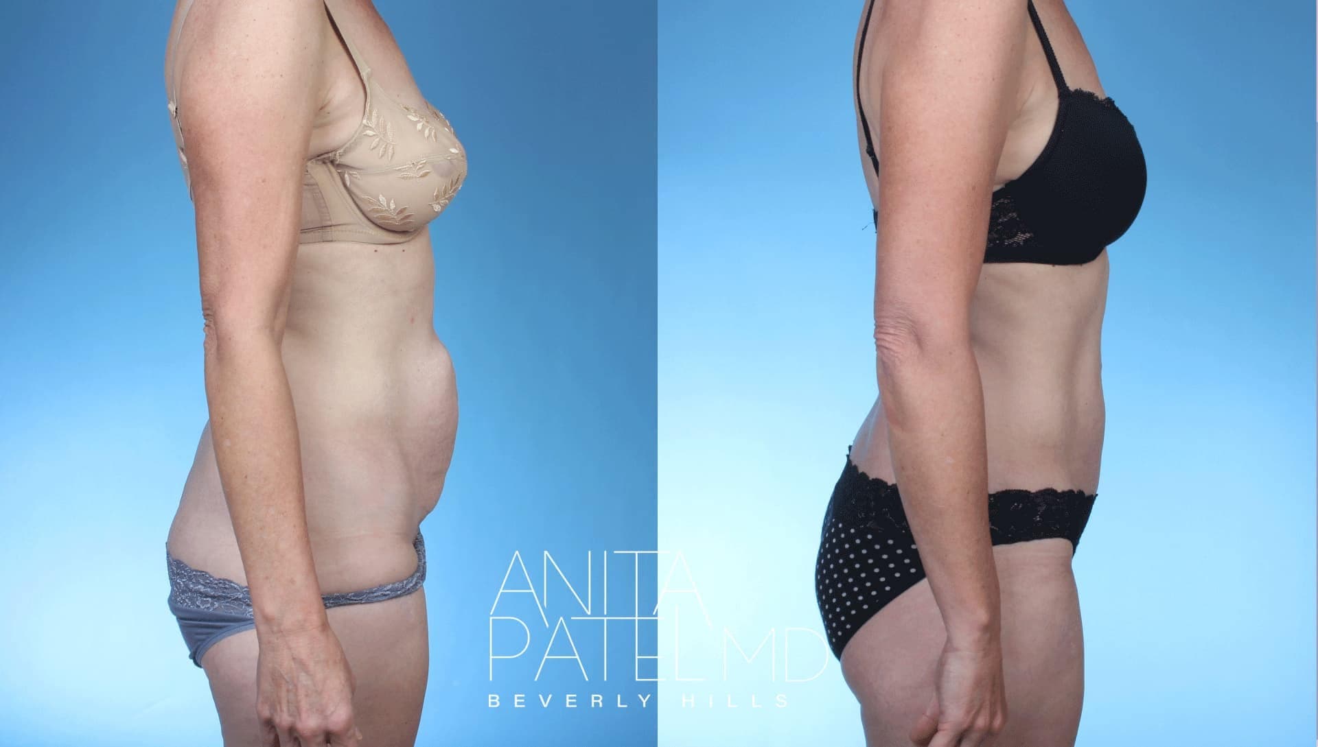 Tummy Tuck before and after — Patient 5 — Dr. Anita Patel, MD, FACS, Beverly Hills