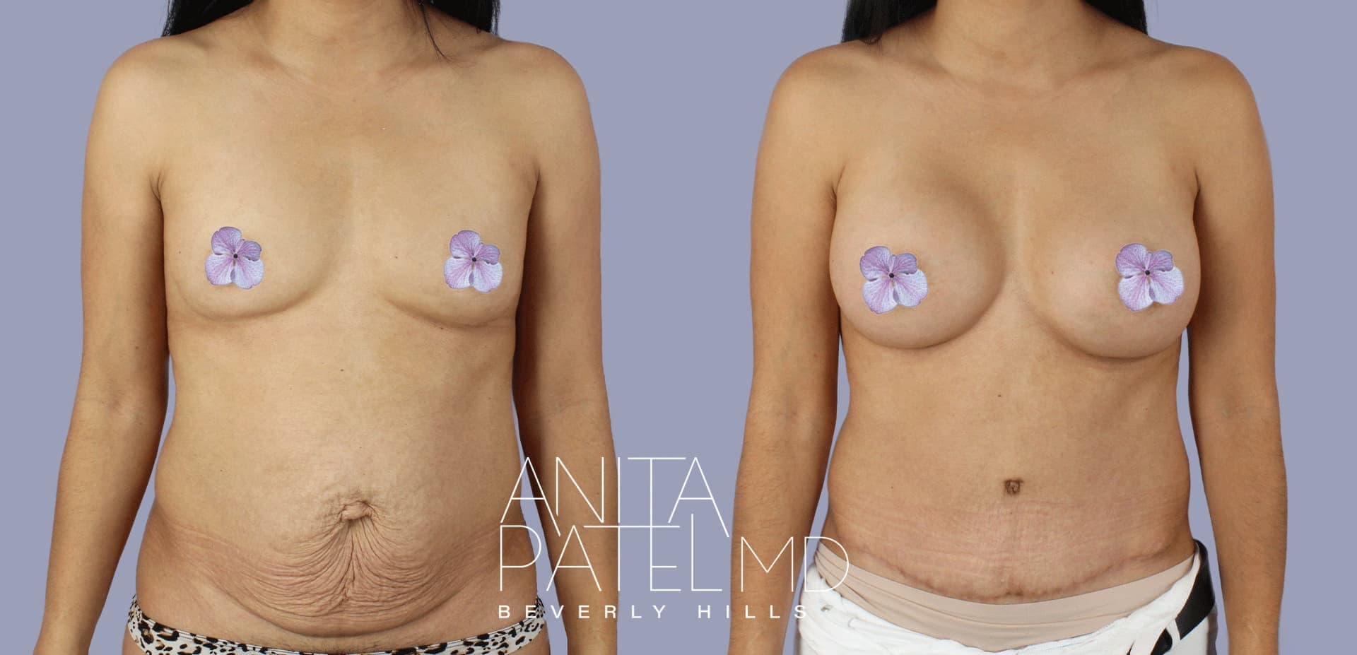 Tummy Tuck before and after — Patient 4, photo 2 of 2 — Dr. Anita Patel, MD, FACS, Beverly Hills
