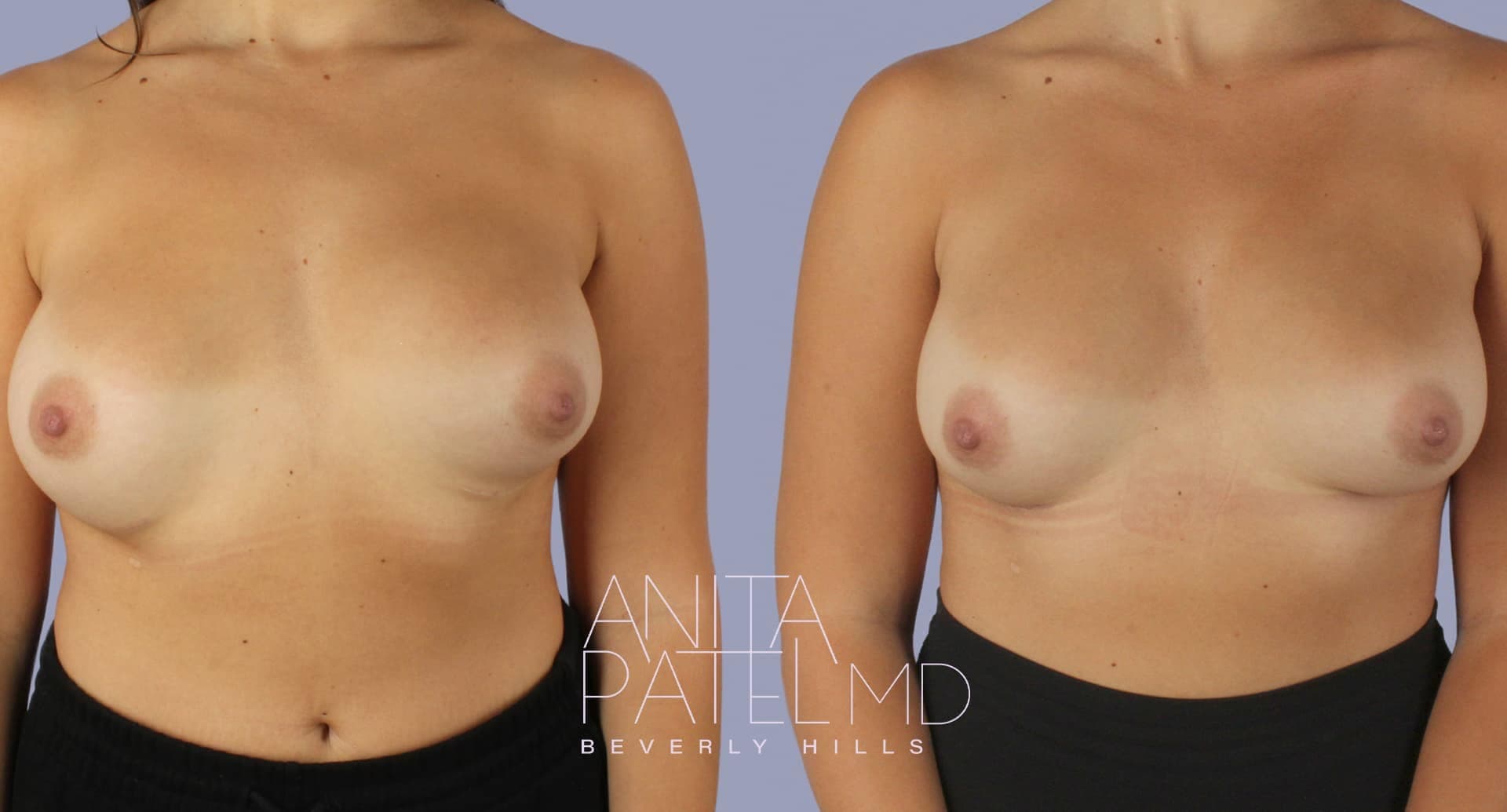Breast Implant Replacement before and after — Patient 1 — Dr. Anita Patel, MD, FACS, Beverly Hills