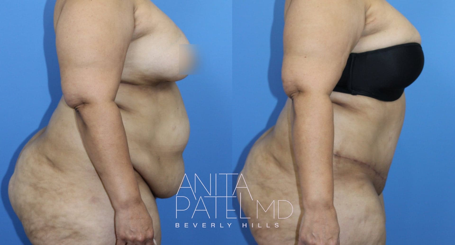 Tummy Tuck before and after — Patient 6 — Dr. Anita Patel, MD, FACS, Beverly Hills
