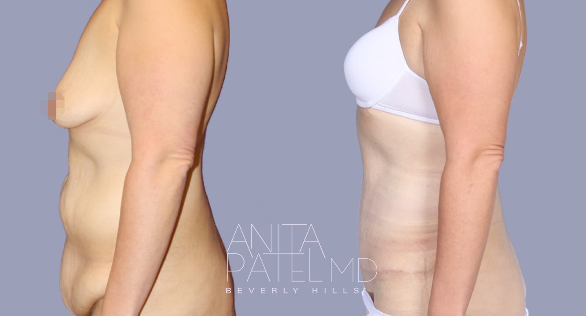 Tummy Tuck before and after — Patient 7, photo 2 of 2 — Dr. Anita Patel, MD, FACS, Beverly Hills