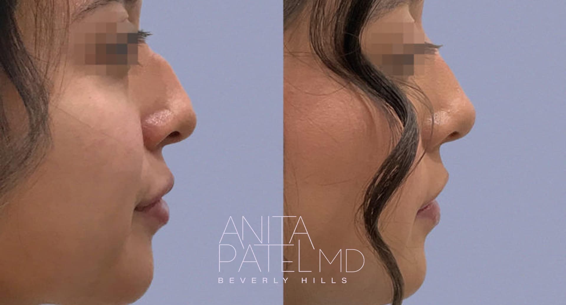 Liquid Rhinoplasty before and after — Dr. Anita Patel, Beverly Hills