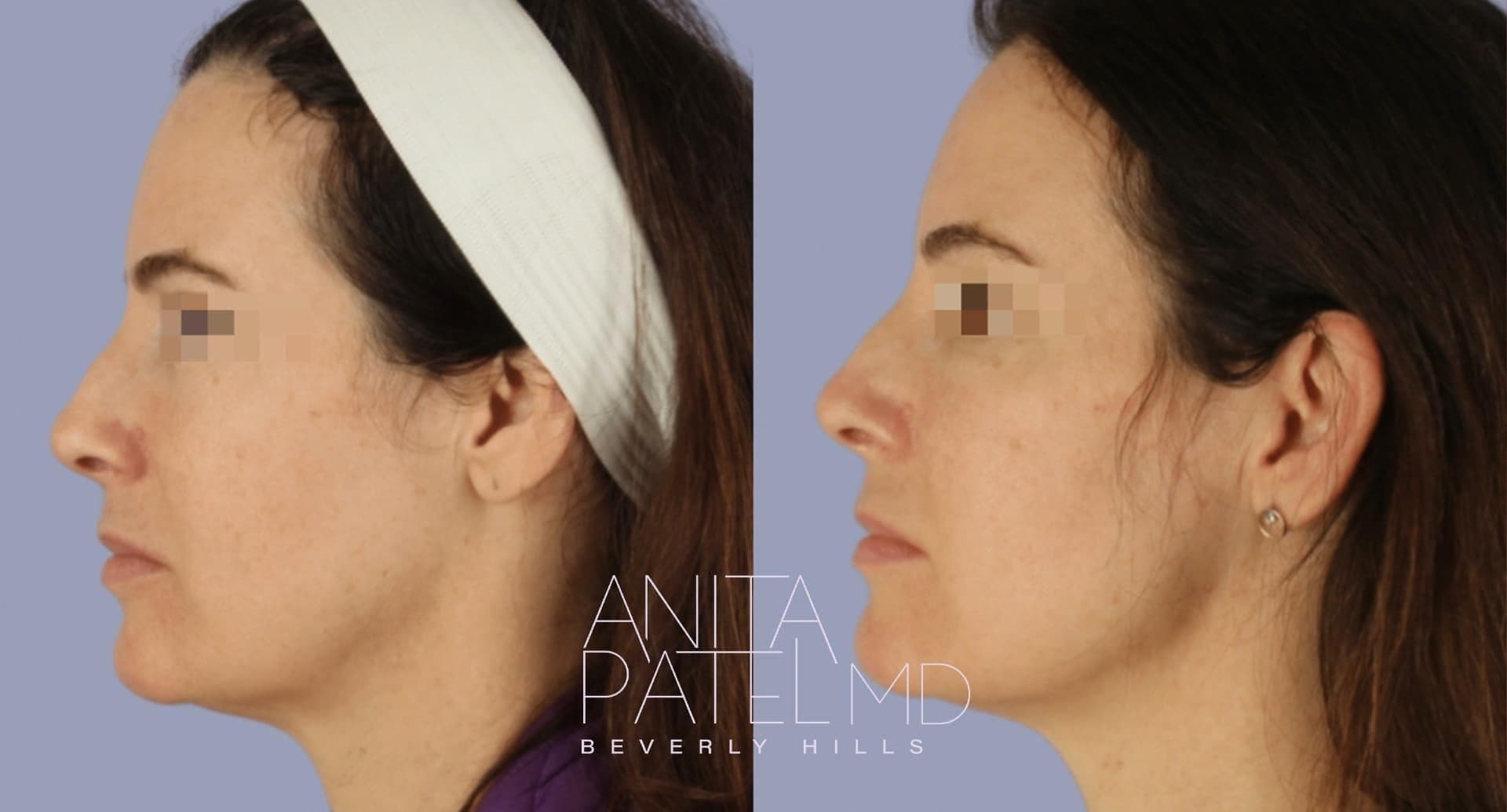 Morpheus8 RF Microneedling before and after — Patient 8 — Dr. Anita Patel, MD, FACS, Beverly Hills
